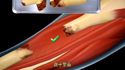 骨折手術(shù)模擬器游戲手機(jī)版截圖4