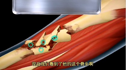 骨折手術(shù)模擬器游戲手機(jī)版截圖5